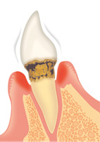歯周病の進行度と治療