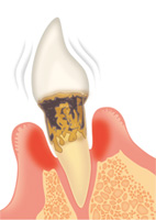 歯周病の進行度と治療